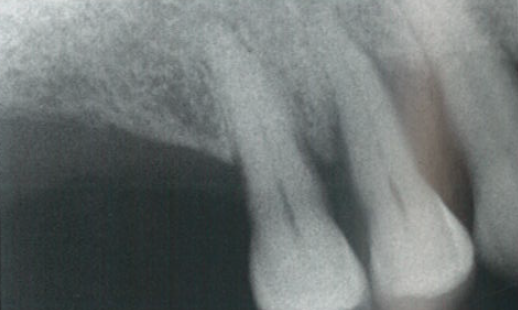 口腔激光怎么治疗“难治性”牙周炎的激光辅助治疗_https://www.jmylbn.com_新闻资讯_第8张