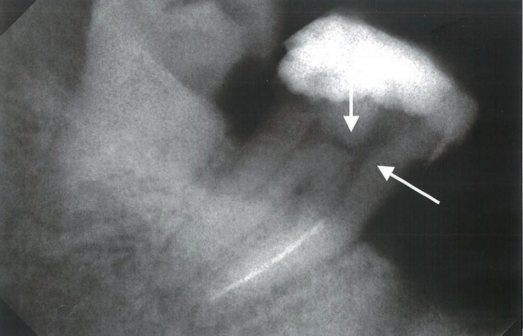 根管马达怎么修根管内器械分离的影响因素_https://www.jmylbn.com_新闻资讯_第2张