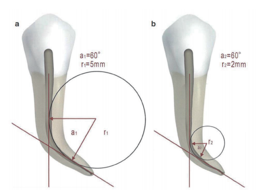 根管马达怎么修根管内器械分离的影响因素_https://www.jmylbn.com_新闻资讯_第5张