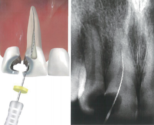 根管马达怎么修根管内器械分离的影响因素_https://www.jmylbn.com_新闻资讯_第3张