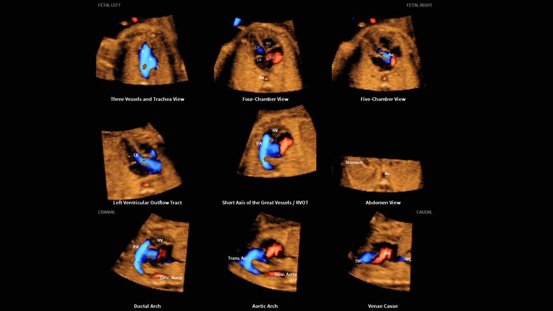 三星彩超怎么样【便民服务】四维彩超界“新王者”——三星HERA女神超声仪，给孕妈妈们一份安心！_https://www.jmylbn.com_新闻资讯_第12张