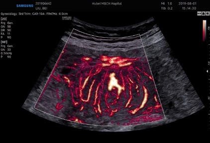 三星彩超怎么样【便民服务】四维彩超界“新王者”——三星HERA女神超声仪，给孕妈妈们一份安心！_https://www.jmylbn.com_新闻资讯_第17张