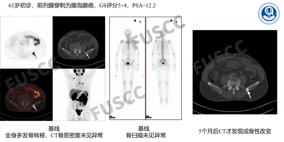 d-spect怎么检查PSMA PET／CT、SPECT／CT检查注意事项_https://www.jmylbn.com_新闻资讯_第3张