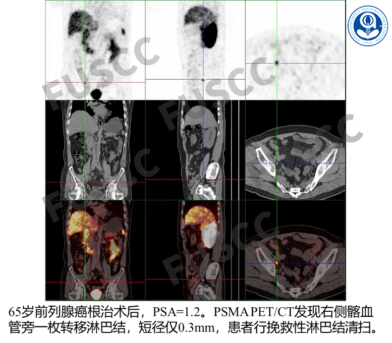 d-spect怎么检查PSMA PET／CT、SPECT／CT检查注意事项_https://www.jmylbn.com_新闻资讯_第5张