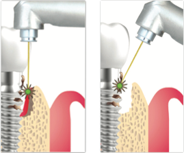 口腔激光怎么治疗口腔特色诊疗——激光治疗_https://www.jmylbn.com_新闻资讯_第6张