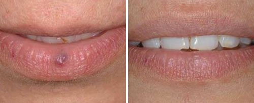 口腔激光怎么治疗口腔特色诊疗——激光治疗_https://www.jmylbn.com_新闻资讯_第14张