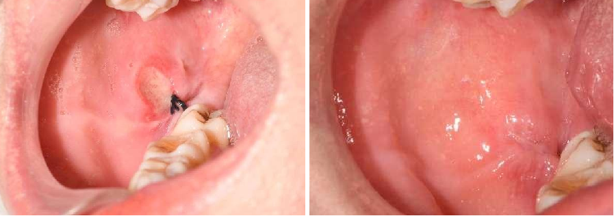 口腔激光怎么治疗口腔特色诊疗——激光治疗_https://www.jmylbn.com_新闻资讯_第12张