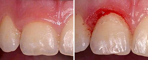 口腔激光怎么治疗口腔特色诊疗——激光治疗_https://www.jmylbn.com_新闻资讯_第11张