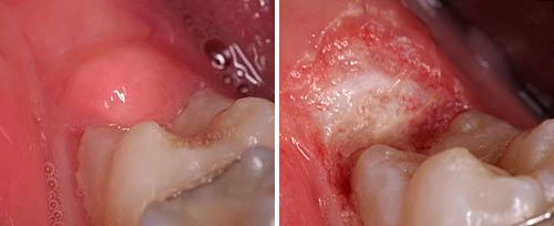口腔激光怎么治疗口腔特色诊疗——激光治疗_https://www.jmylbn.com_新闻资讯_第10张