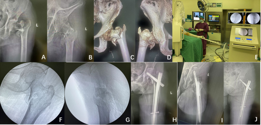 在没有牵引床的情况下，一种简单的牵引方法髓内钉固定粗隆间骨折