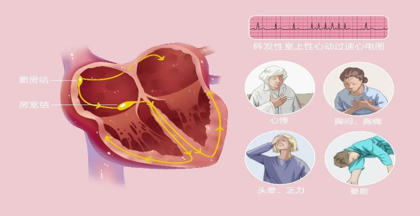 心电图机怎么修精准维修”重获“心”生 ｜ 永城市胸痛中心成功救治56岁心跳“飙车”大叔！_https://www.jmylbn.com_新闻资讯_第16张