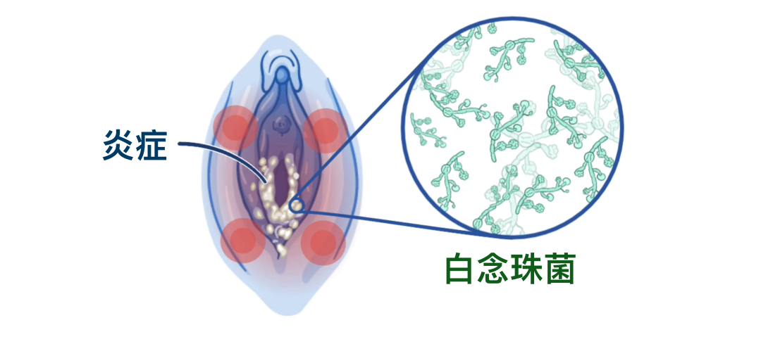 外阴道念珠菌病