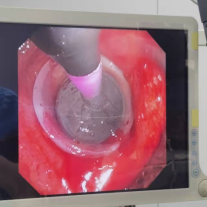 什么牌子的气管好孩子肺炎老不好，医生让做的气管镜到底是什么？_https://www.jmylbn.com_新闻资讯_第27张