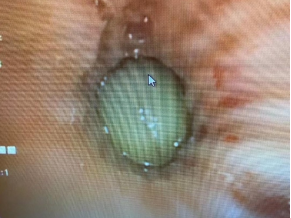 什么牌子的气管好孩子肺炎老不好，医生让做的气管镜到底是什么？_https://www.jmylbn.com_新闻资讯_第16张