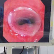 什么牌子的气管好孩子肺炎老不好，医生让做的气管镜到底是什么？_https://www.jmylbn.com_新闻资讯_第28张