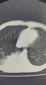 什么牌子的气管好孩子肺炎老不好，医生让做的气管镜到底是什么？_https://www.jmylbn.com_新闻资讯_第6张