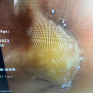 什么牌子的气管好孩子肺炎老不好，医生让做的气管镜到底是什么？_https://www.jmylbn.com_新闻资讯_第11张