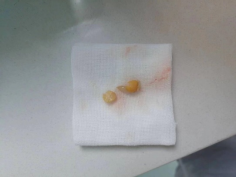 什么牌子的气管好孩子肺炎老不好，医生让做的气管镜到底是什么？_https://www.jmylbn.com_新闻资讯_第17张