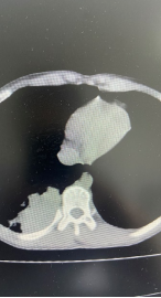 什么牌子的气管好孩子肺炎老不好，医生让做的气管镜到底是什么？_https://www.jmylbn.com_新闻资讯_第7张