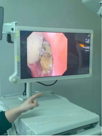 什么牌子的气管好孩子肺炎老不好，医生让做的气管镜到底是什么？_https://www.jmylbn.com_新闻资讯_第18张