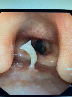 什么牌子的气管好孩子肺炎老不好，医生让做的气管镜到底是什么？_https://www.jmylbn.com_新闻资讯_第14张