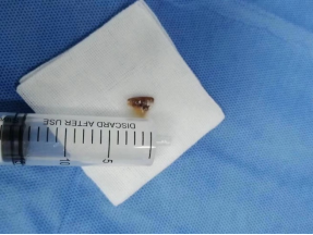 什么牌子的气管好孩子肺炎老不好，医生让做的气管镜到底是什么？_https://www.jmylbn.com_新闻资讯_第12张