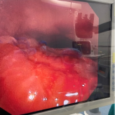 什么牌子的气管好孩子肺炎老不好，医生让做的气管镜到底是什么？_https://www.jmylbn.com_新闻资讯_第25张