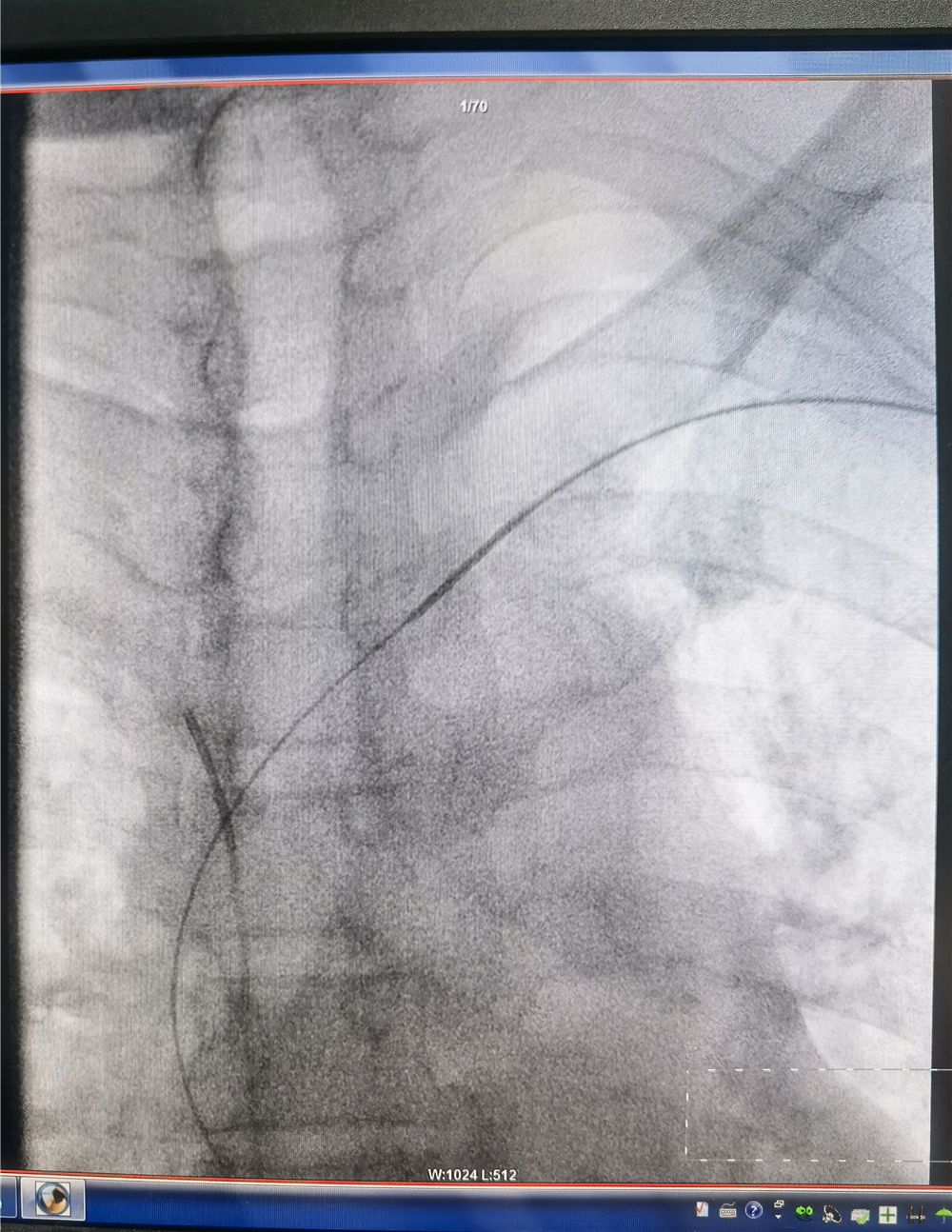 塞球囊怎么取开通闭塞血管，守住透析“生命线”——山东省中医院完成首例头臂静脉闭塞球囊扩张成形术_https://www.jmylbn.com_新闻资讯_第4张