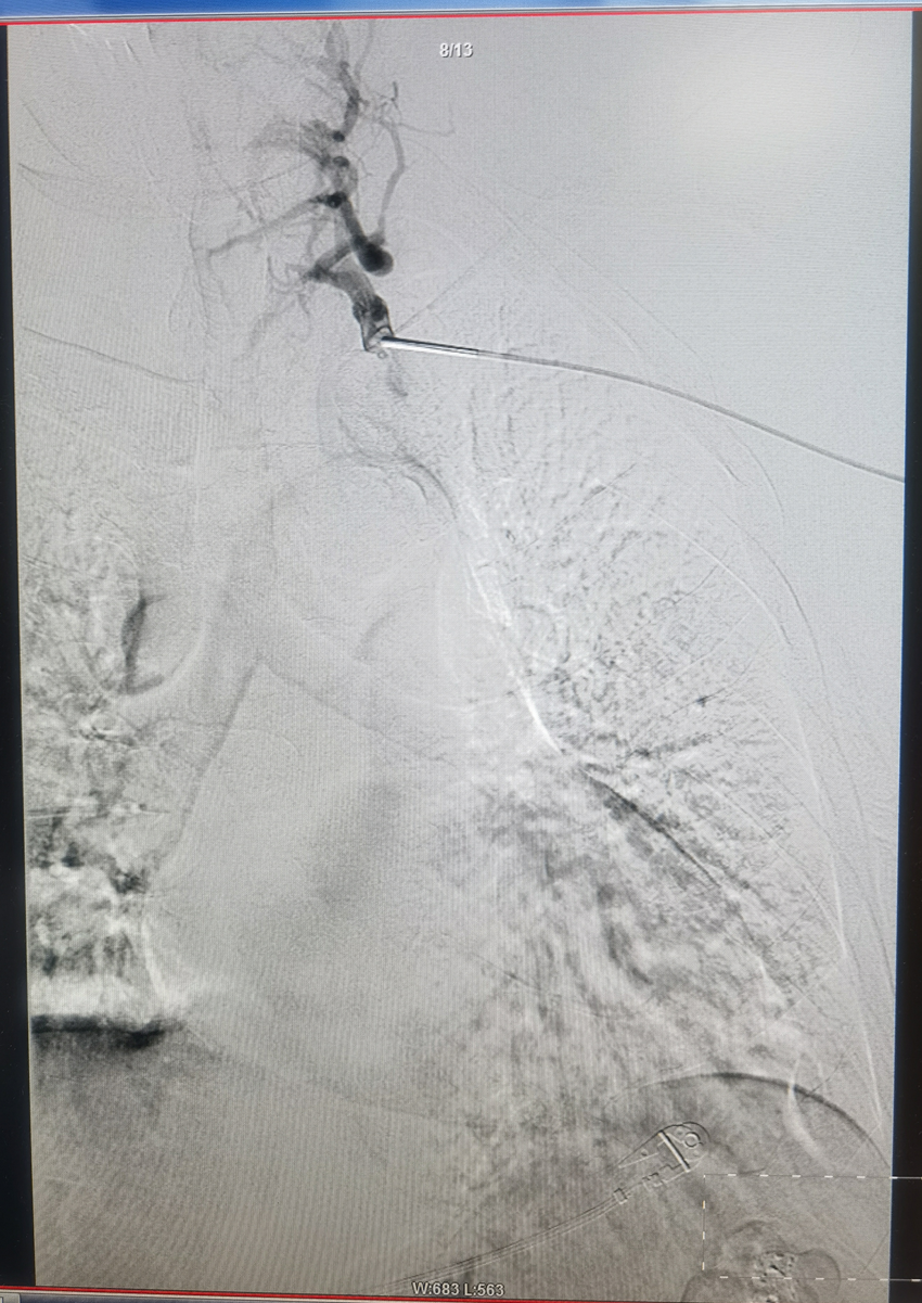 塞球囊怎么取开通闭塞血管，守住透析“生命线”——山东省中医院完成首例头臂静脉闭塞球囊扩张成形术_https://www.jmylbn.com_新闻资讯_第2张