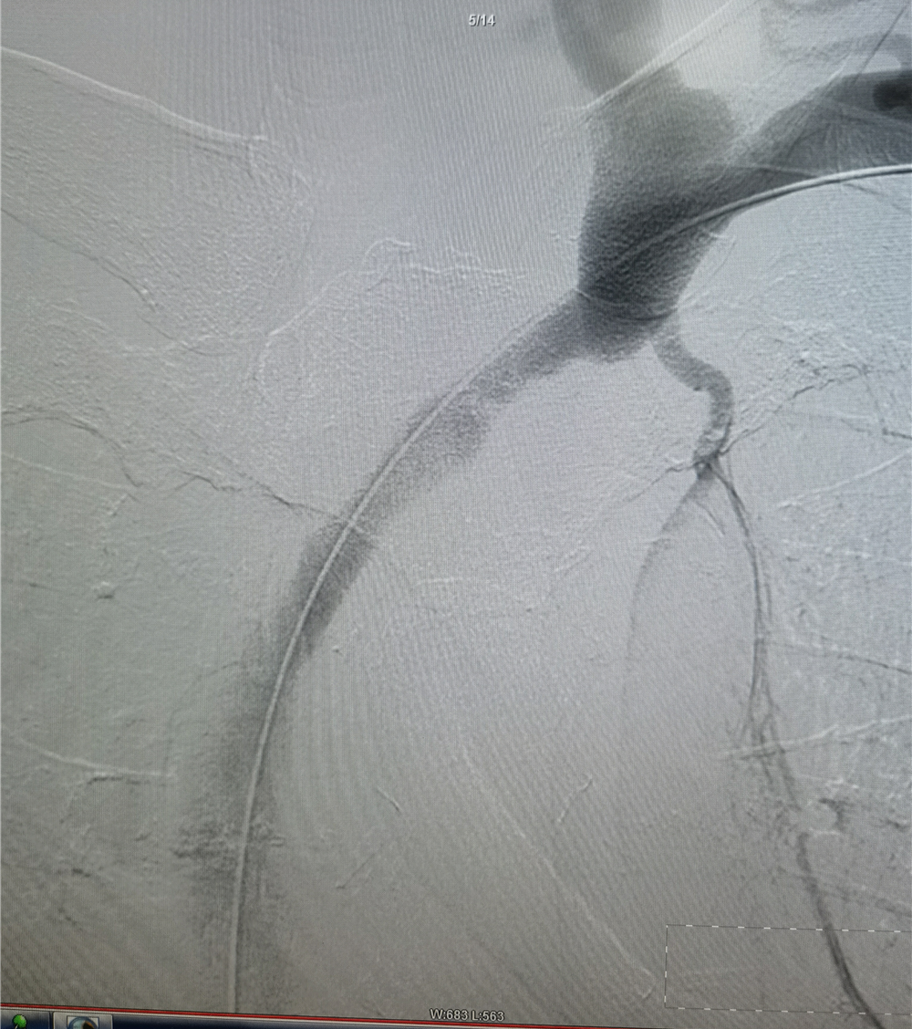 塞球囊怎么取开通闭塞血管，守住透析“生命线”——山东省中医院完成首例头臂静脉闭塞球囊扩张成形术_https://www.jmylbn.com_新闻资讯_第5张