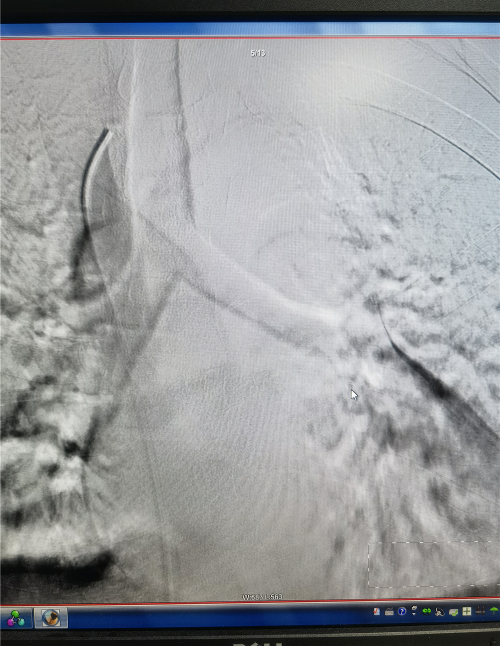 塞球囊怎么取开通闭塞血管，守住透析“生命线”——山东省中医院完成首例头臂静脉闭塞球囊扩张成形术_https://www.jmylbn.com_新闻资讯_第3张