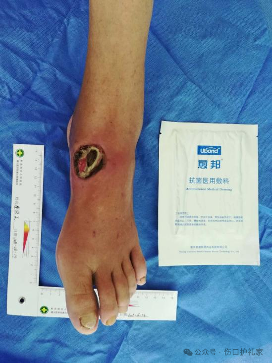 为什么用银敷含银敷料（Silver Dressing）_https://www.jmylbn.com_新闻资讯_第7张