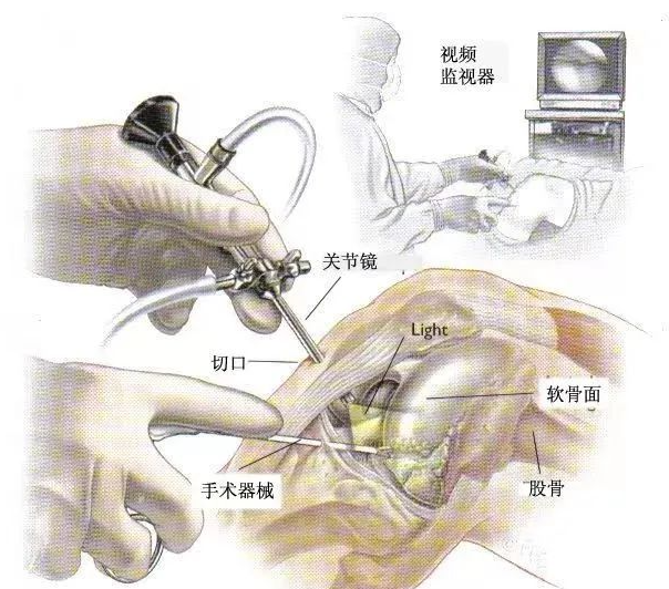 为什么叫美国施乐辉【新增“利器“】开阳县人民医院引进美国“施乐辉”全高清数字化关节镜系统_https://www.jmylbn.com_新闻资讯_第6张