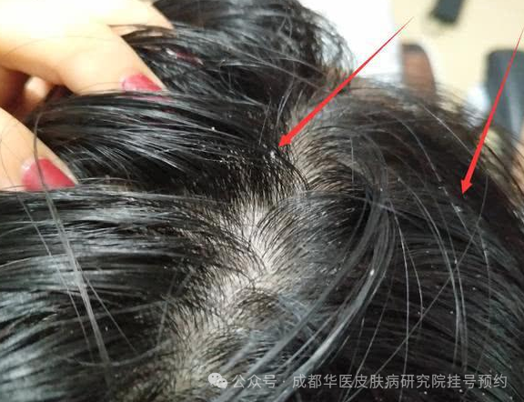 男人头发油腻掉发的真相揭示！告别油腻，重拾自信，从这里开始！