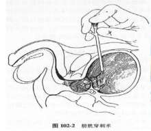 集尿袋是什么意思【科普小知识】留置导尿管及膀胱造瘘管日常护理_https://www.jmylbn.com_新闻资讯_第12张