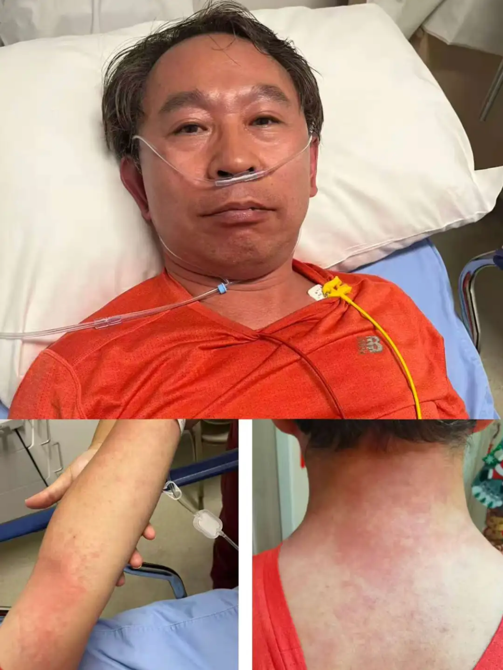 协和专家吃头孢过敏,协和专家吃头孢遇险：我成了被抢救的人！“以前不过敏，没喝酒”..