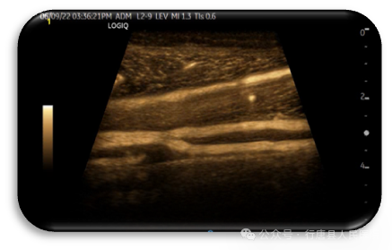 logiq e怎么读【高端设备】从多个维度观察血管、组织的血流灌注、像素合成在瞬间完成——美国GE超声高端旗舰机LOGIQ™ E11_https://www.jmylbn.com_新闻资讯_第11张