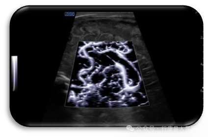 logiq e怎么读【高端设备】从多个维度观察血管、组织的血流灌注、像素合成在瞬间完成——美国GE超声高端旗舰机LOGIQ™ E11_https://www.jmylbn.com_新闻资讯_第12张