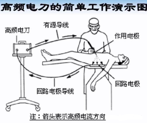 怎么贴负极板【为您解答】做手术时为什么身上要贴一个冰冰凉的东西？_https://www.jmylbn.com_新闻资讯_第30张