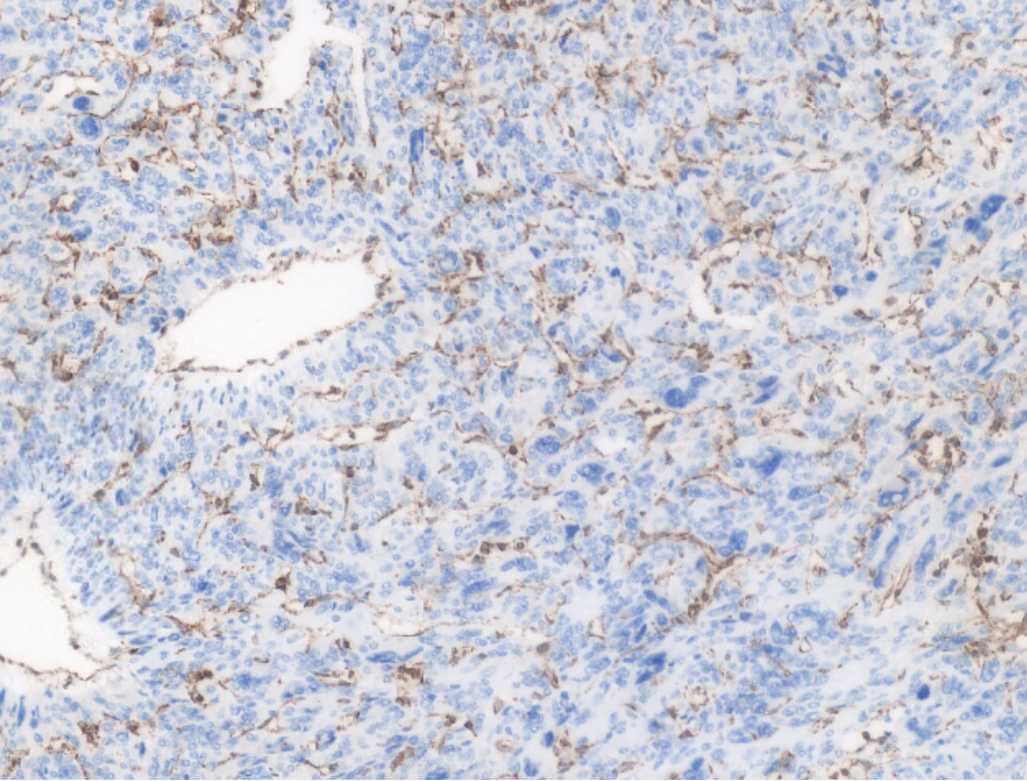 fh染色是什么意思讲座｜ FH缺失型子宫平滑肌瘤_https://www.jmylbn.com_新闻资讯_第25张