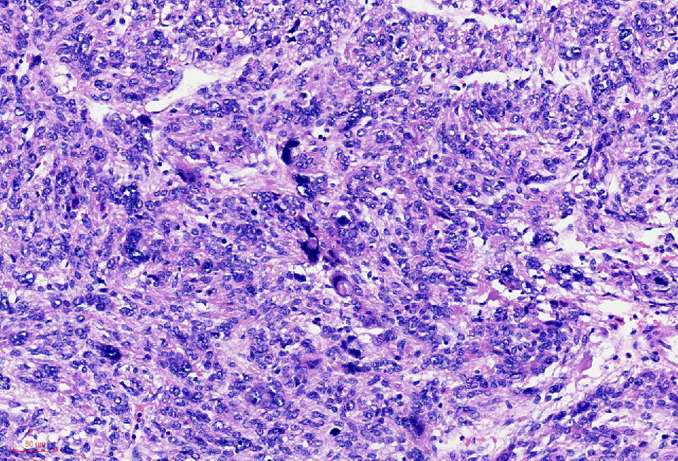 fh染色是什么意思讲座｜ FH缺失型子宫平滑肌瘤_https://www.jmylbn.com_新闻资讯_第15张