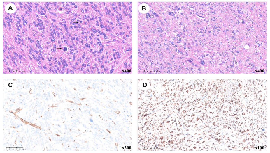 fh染色是什么意思讲座｜ FH缺失型子宫平滑肌瘤_https://www.jmylbn.com_新闻资讯_第32张