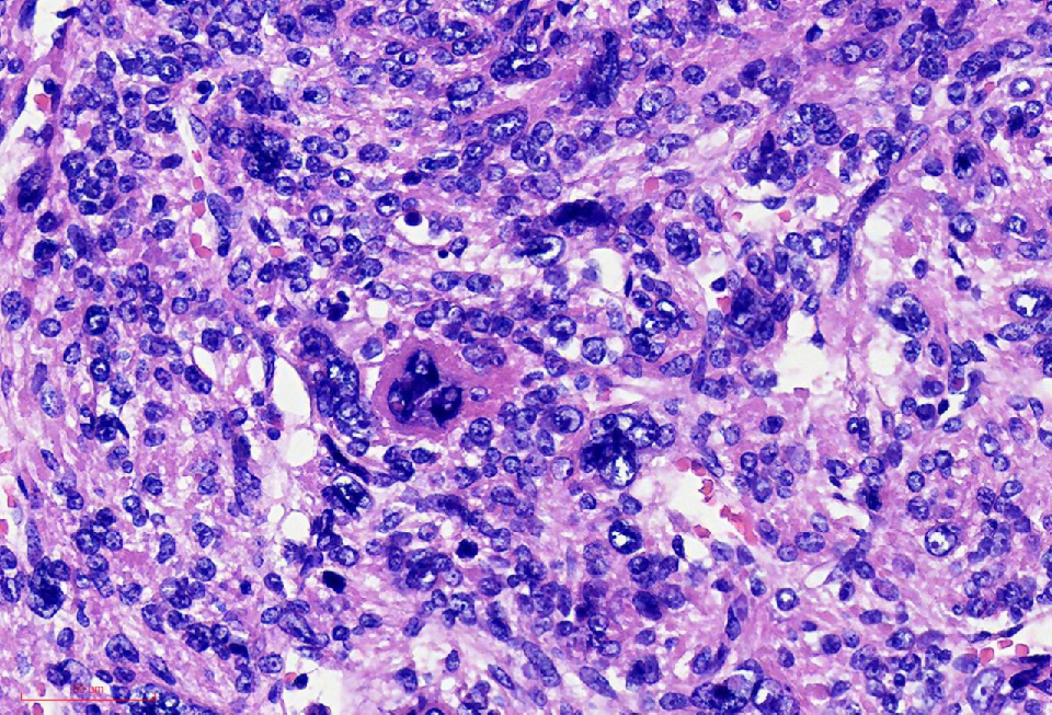 fh染色是什么意思讲座｜ FH缺失型子宫平滑肌瘤_https://www.jmylbn.com_新闻资讯_第22张