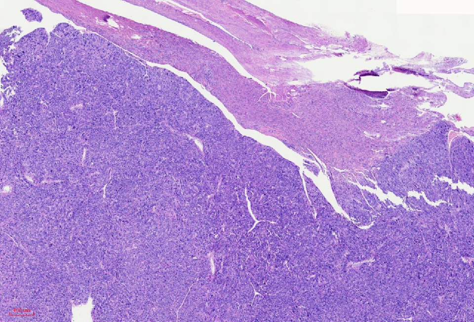 fh染色是什么意思讲座｜ FH缺失型子宫平滑肌瘤_https://www.jmylbn.com_新闻资讯_第8张