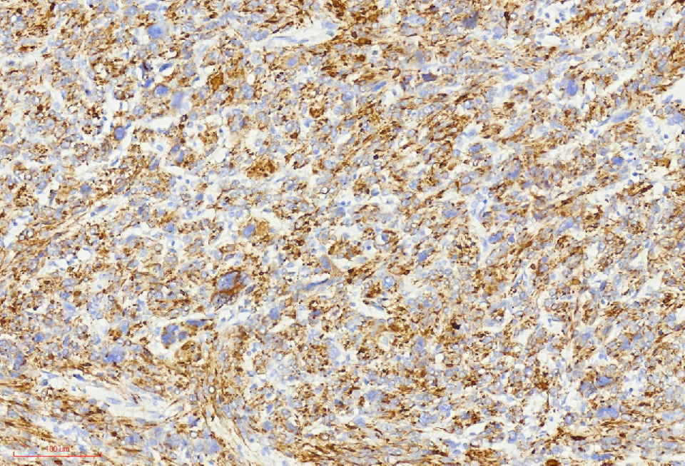 fh染色是什么意思讲座｜ FH缺失型子宫平滑肌瘤_https://www.jmylbn.com_新闻资讯_第23张