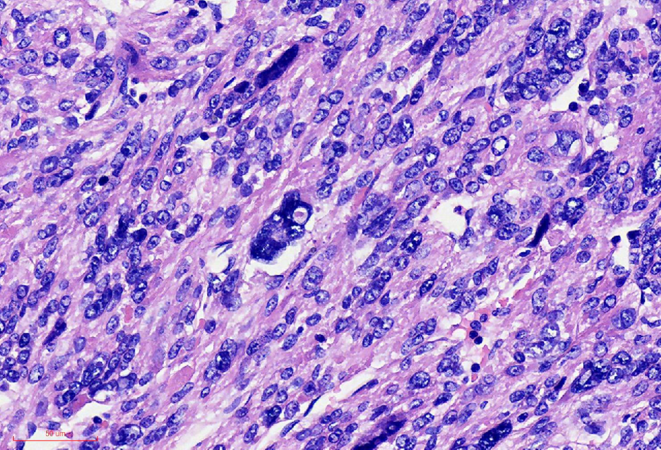 fh染色是什么意思讲座｜ FH缺失型子宫平滑肌瘤_https://www.jmylbn.com_新闻资讯_第21张