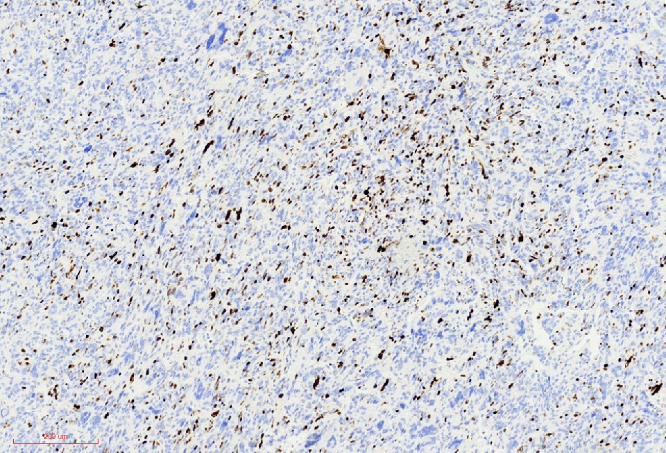 fh染色是什么意思讲座｜ FH缺失型子宫平滑肌瘤_https://www.jmylbn.com_新闻资讯_第28张