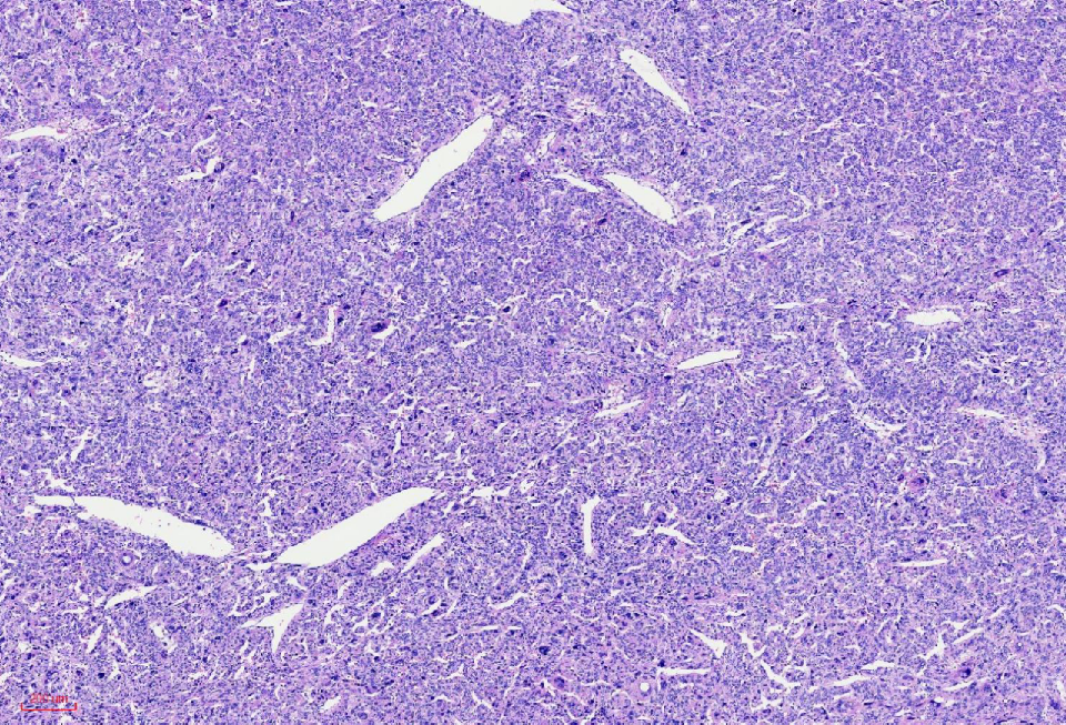 fh染色是什么意思讲座｜ FH缺失型子宫平滑肌瘤_https://www.jmylbn.com_新闻资讯_第11张