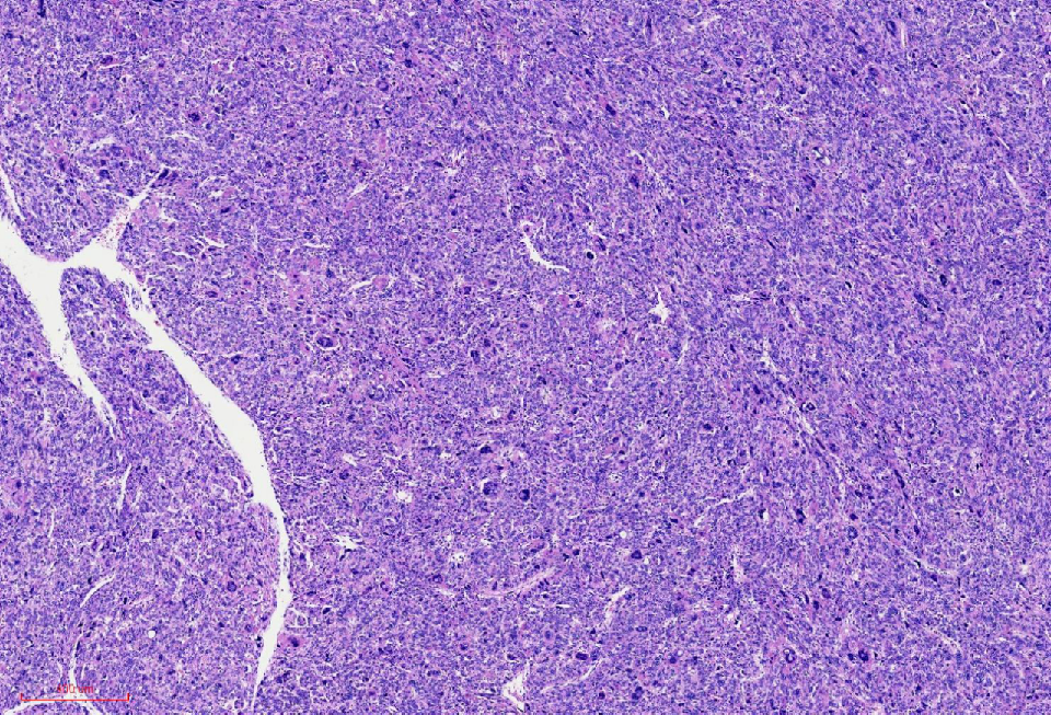 fh染色是什么意思讲座｜ FH缺失型子宫平滑肌瘤_https://www.jmylbn.com_新闻资讯_第10张