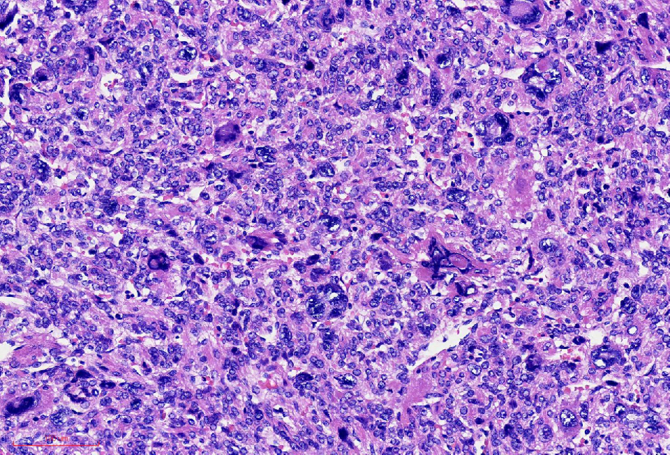 fh染色是什么意思讲座｜ FH缺失型子宫平滑肌瘤_https://www.jmylbn.com_新闻资讯_第17张